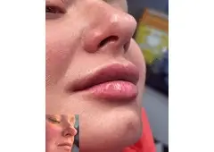 Best Service For Dermal Fillers in Grimsargh