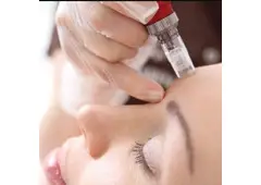 Best Microneedling treatment in West Watford