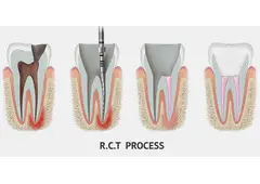 Save Your Tooth – Advanced Root Canal Treatment in Noida