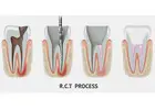 Save Your Tooth – Advanced Root Canal Treatment in Noida