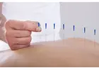 Best Acupuncture Therapist in Paddington